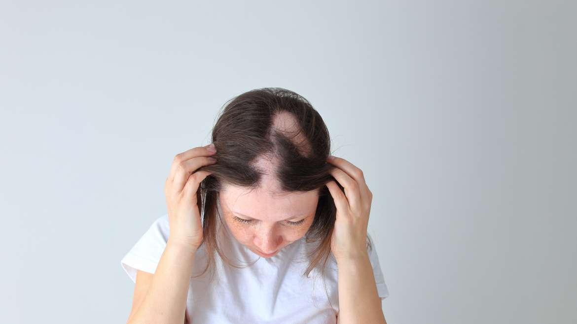 Alopecia (Hair Loss)